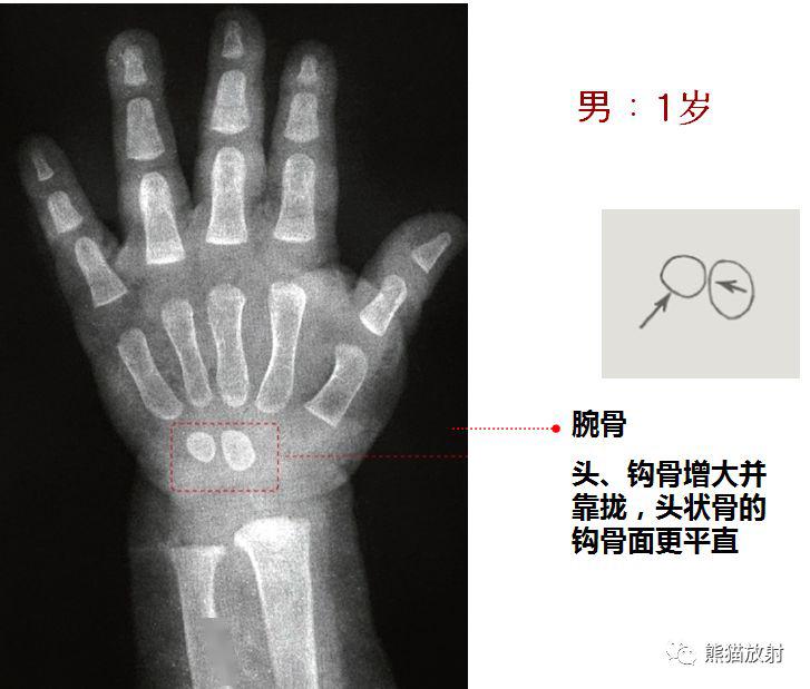 收藏丨骨龄图谱!(方便随时对照)_年龄