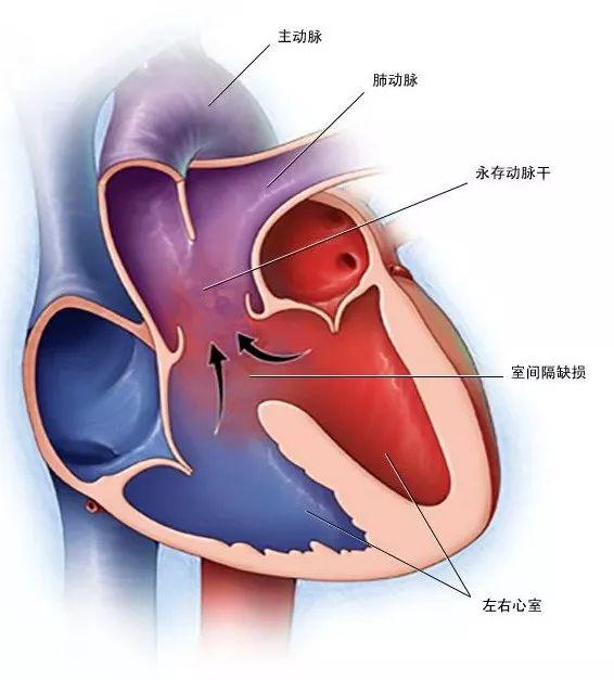 图20 永存动脉干合并室间隔缺损(图中红色代表富氧血,蓝色代表乏氧血