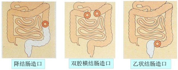 中国100万造口人改道的肠子改变的人生