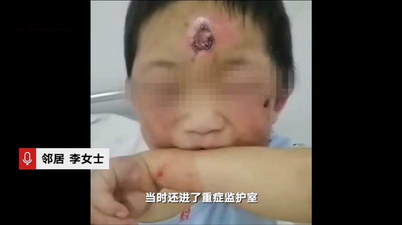 4岁女童被继母打进icu身上多处烟头烫伤亲父行为遭众人质疑
