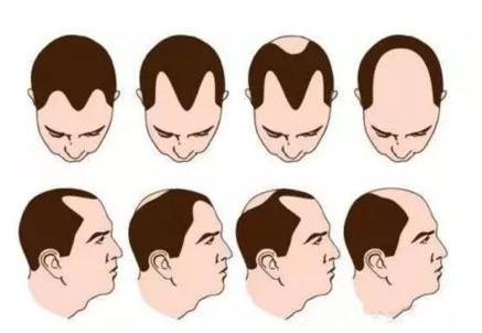 其表现为进行性头发直径的变细,头发密度的降低和脱发,直至出现不同