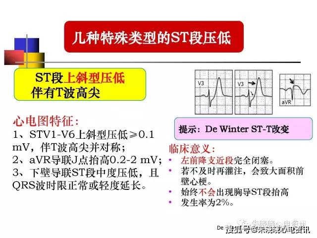 心电图st段下移危险分析