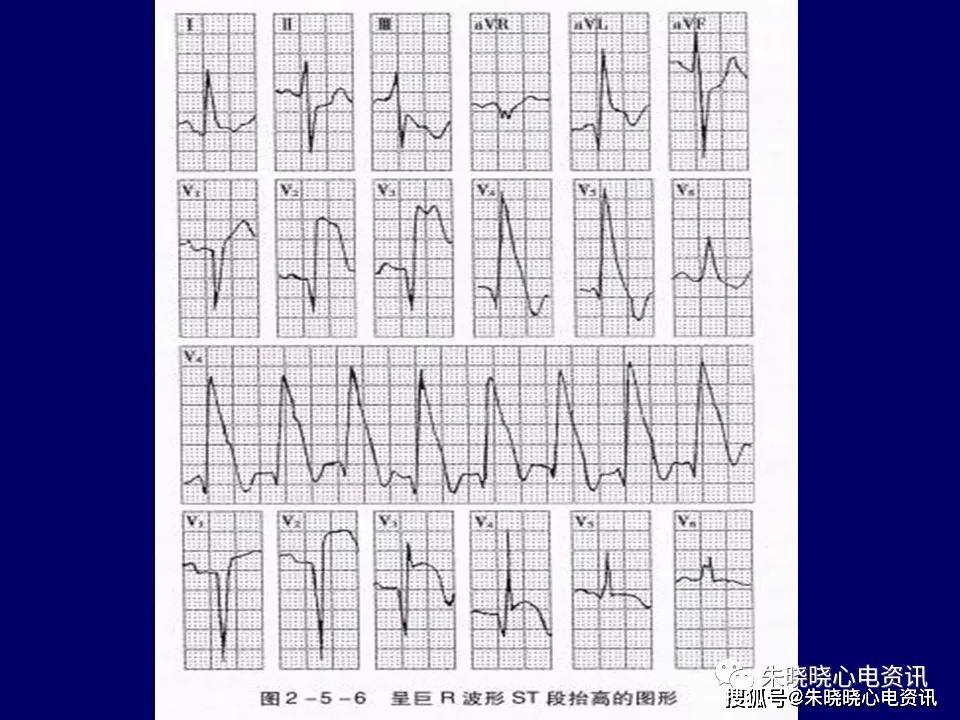 心电图危急值识别与诊断