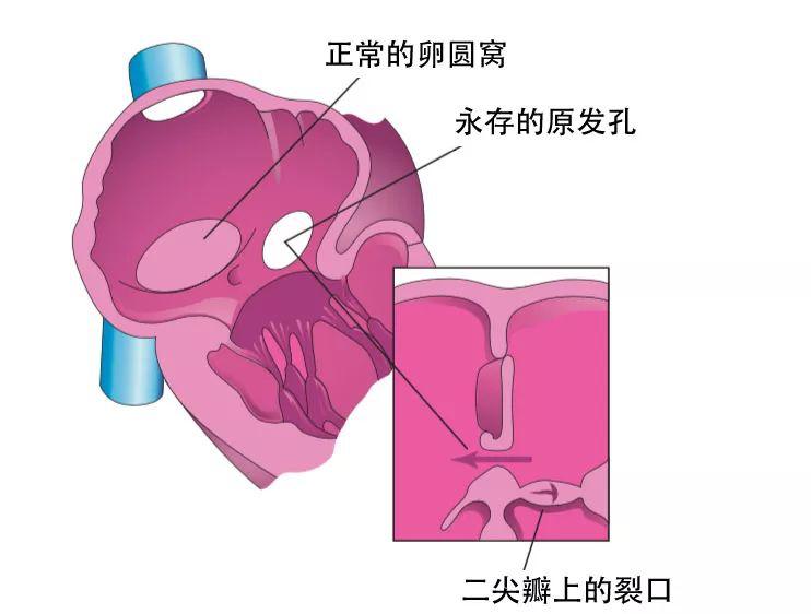 图16 原发孔型房间隔缺损,伴有二尖瓣异常随后,在原发隔形成继发孔