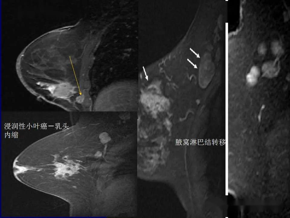 了解磁共振是如何诊断乳腺癌的