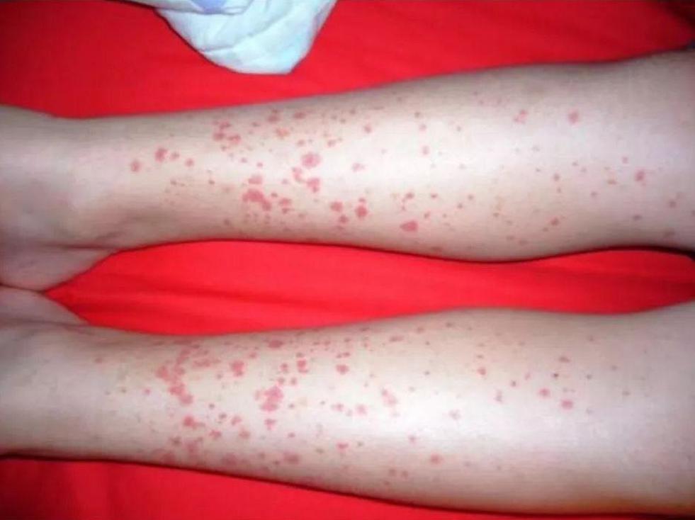 孩子脚上长了很多小红点,以为只是普通过敏,没想到后果可能这么严重!