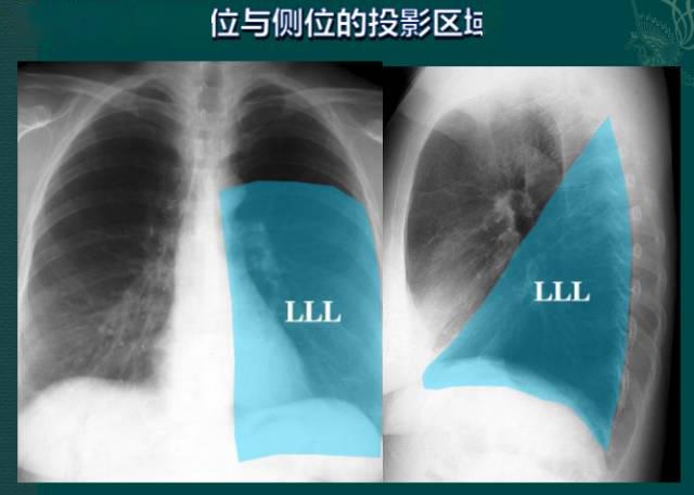 读完此文,终于学会看胸片了_纵隔