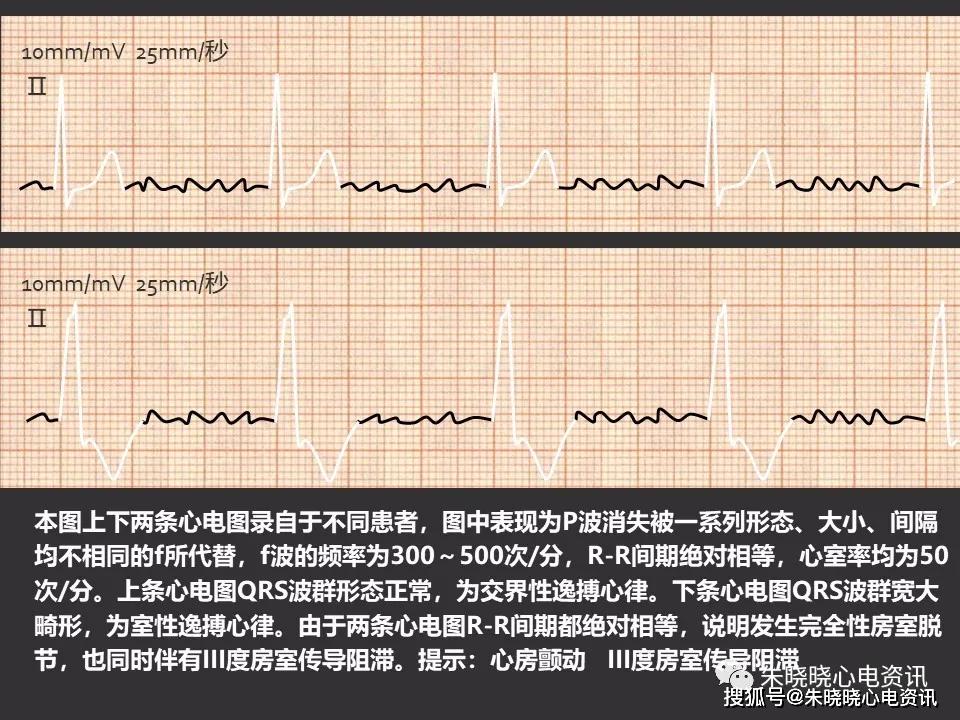 房室传导阻滞(ppt)