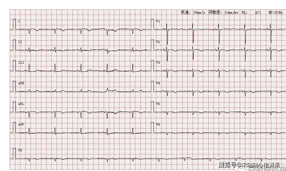 =心电读图=_体检