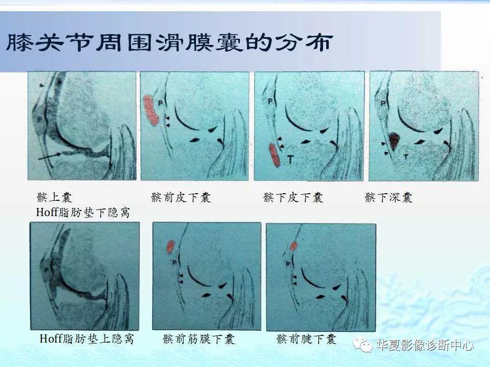 认识这些滑膜囊-诊断不再困惑!