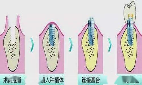 种植牙和拔牙对比解读种一颗牙你要承受多少创伤