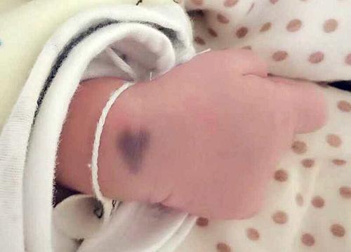 「影响」多半是妈妈孕期做了4件事宝宝出生后因胎记“毁”颜值