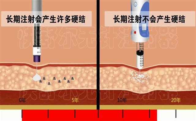 临床证实无针注射胰岛素可避免硬结硬块儿产生_注射器