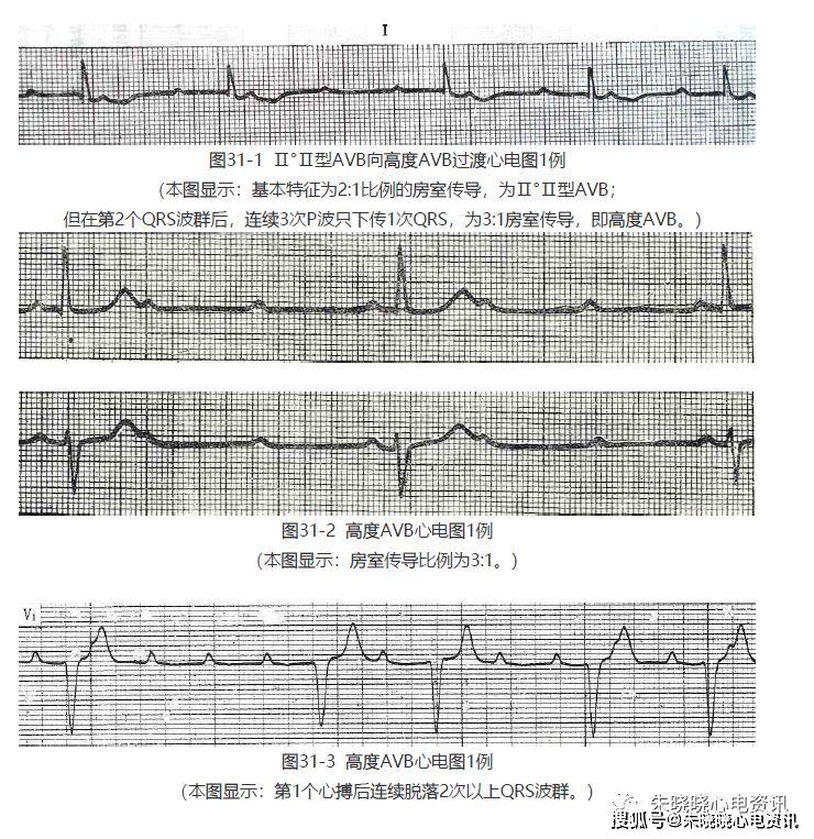 房室传导阻滞(二)