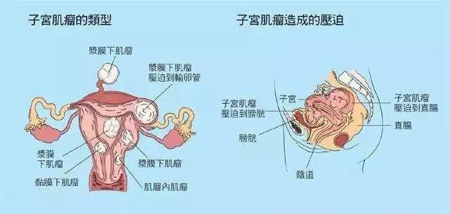 可引发内膜炎,出现月经异常①发生在子宫底部浆膜层下的子宫肌瘤,若
