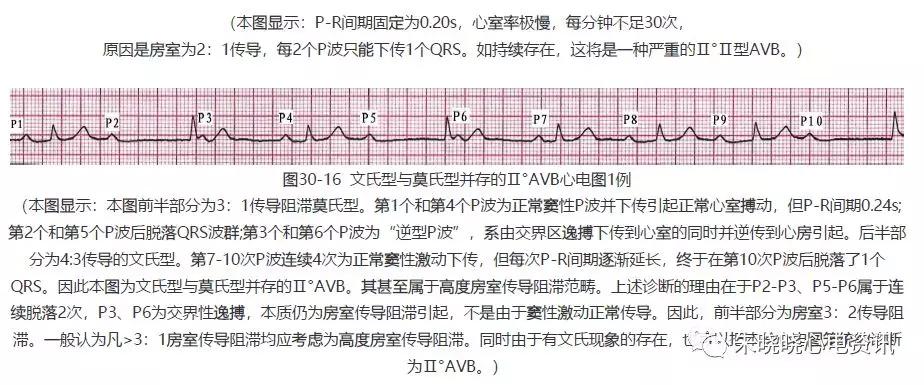 房室传导阻滞（一）