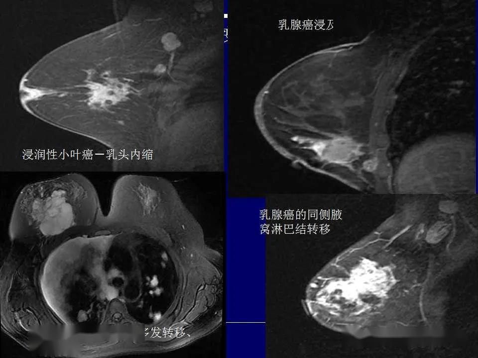 了解磁共振是如何诊断乳腺癌的