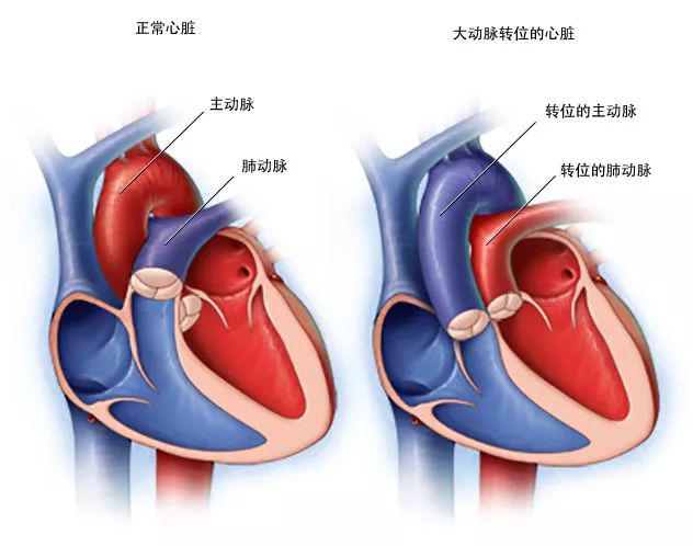 图21 大动脉转位的心脏与正常心脏的比较