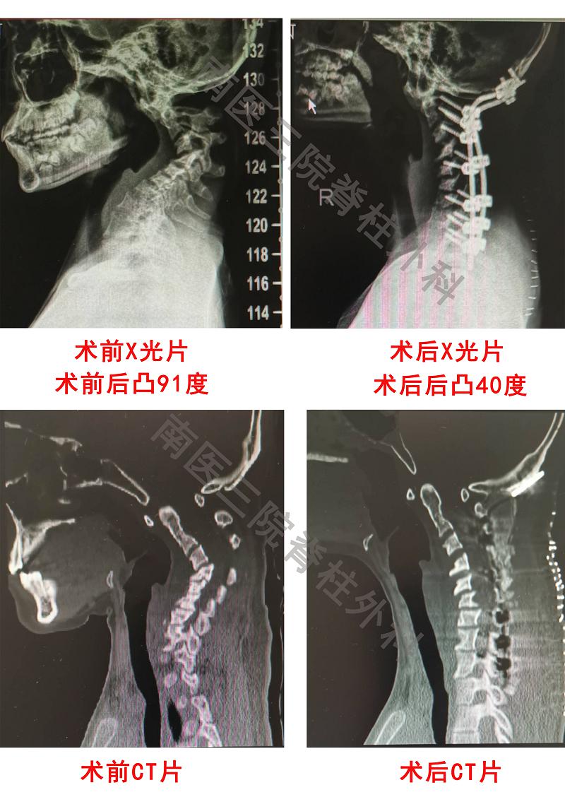 花季少女患罕见病 颈椎严重弯曲变形_手术