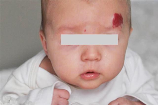 「影响」多半是妈妈孕期做了4件事宝宝出生后因胎记“毁”颜值