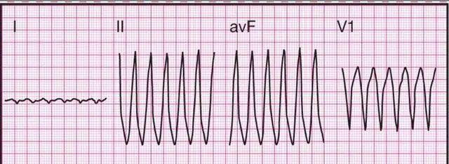临床干货 | 14种异常心电图的波形特点