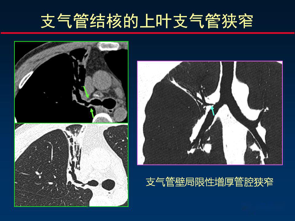 柳澄讲坛丨正确判读支气管异常的ct征象