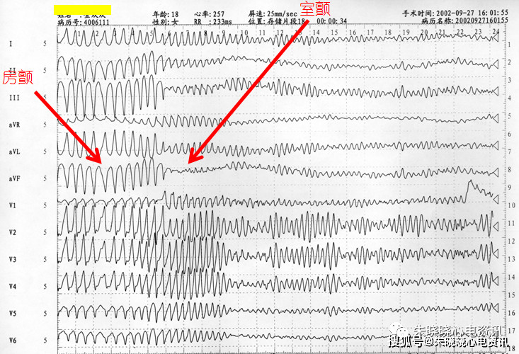 恶性房颤心电图,下图中房颤蜕变为室颤.