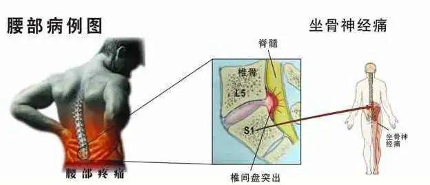 腰椎间盘突出症和腰肌劳损,你还傻傻分不清楚吗?