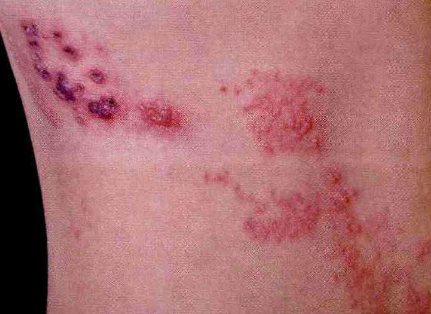 是由水痘---带状疱疹病毒引起的急性炎症性皮肤病,中医称为"缠腰火