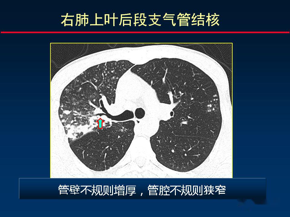 柳澄讲坛丨正确判读支气管异常的ct征象