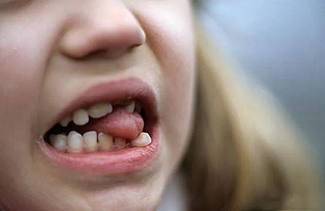 咬唇习惯:咬上唇和咬下唇习惯相对容易被家长发现,出现时都应当及时