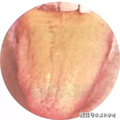 舌头就是健康"显示器",从3个方面教你中医辨证,简单易