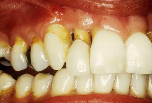 牙齿敏感到底是怎么回事?