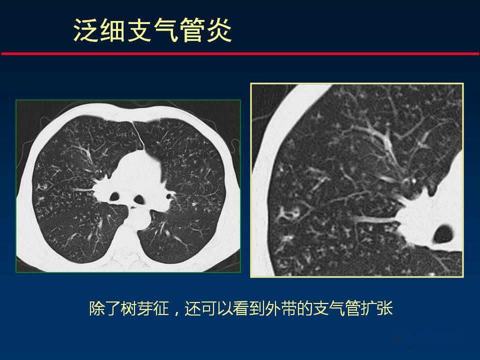 柳澄讲坛丨正确判读支气管异常的ct征象