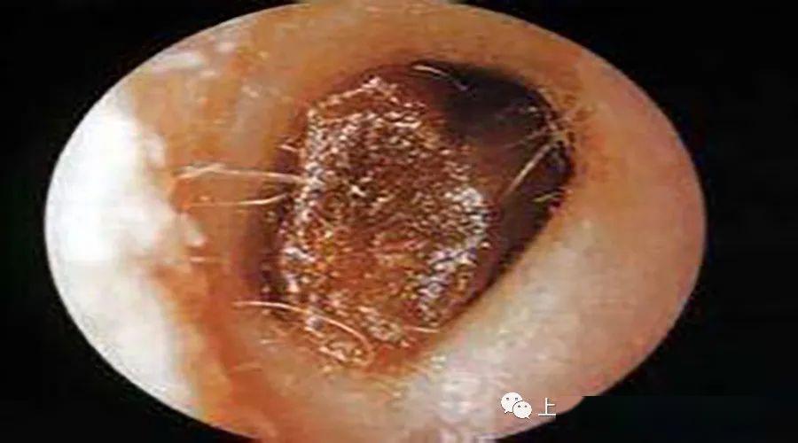 耳屎也能提示我们耳朵的健康状况吗