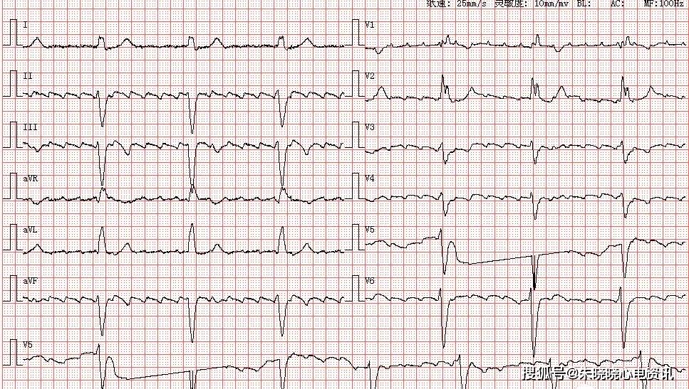 患者女,72岁,有心房扑动病史,图为其入院抢救心电图