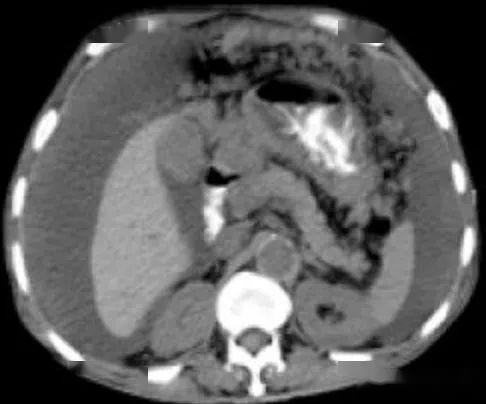 腹腔积液的ct诊断