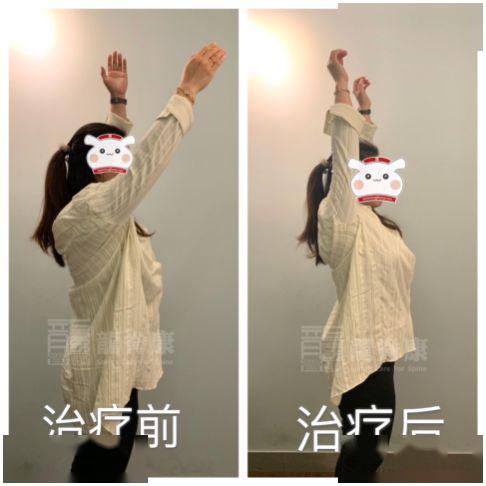 病例真没想到肩膀疼痛竟然也和含胸驼背有关