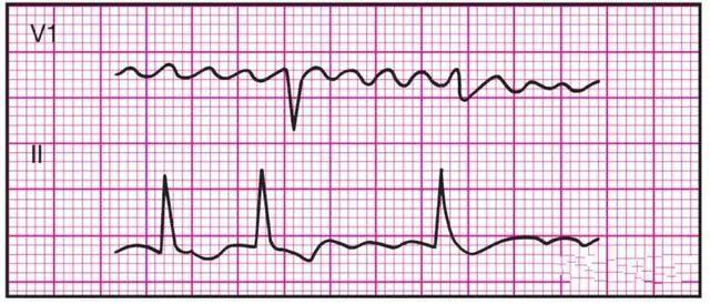 临床干货 | 14种异常心电图的波形特点
