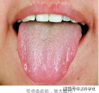 正常舌象的舌质颜色比这个要红,而且 舌边是比较红润的.