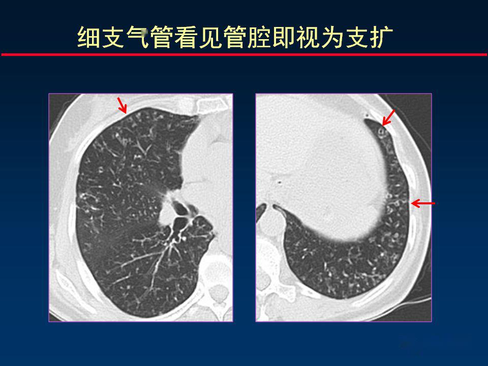 柳澄讲坛丨正确判读支气管异常的ct征象