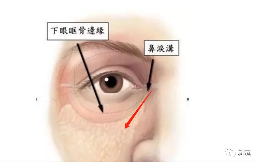 泪沟其实是下眼眶骨边缘靠近鼻侧的一条凹沟.