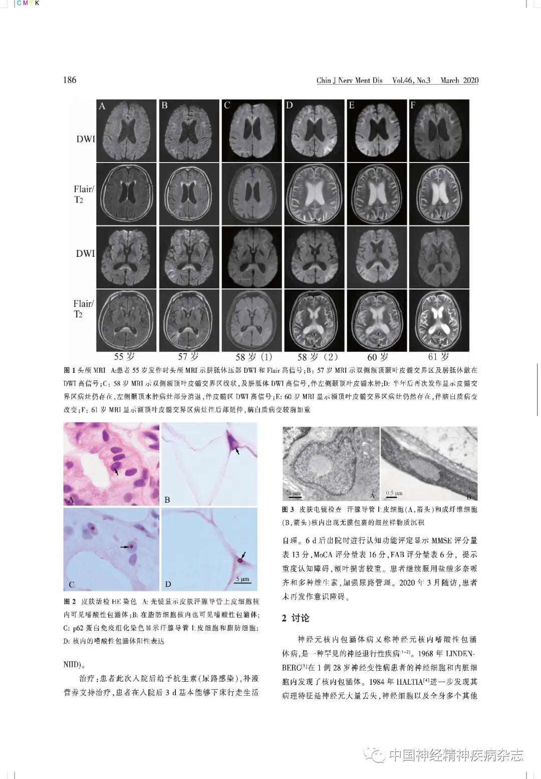 罕见病专栏老年男性排尿障碍9年发作性意识障碍7年神经元核内包涵体病