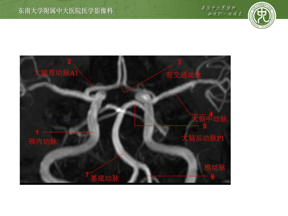 解剖 头部血管解剖及willis环常见变异