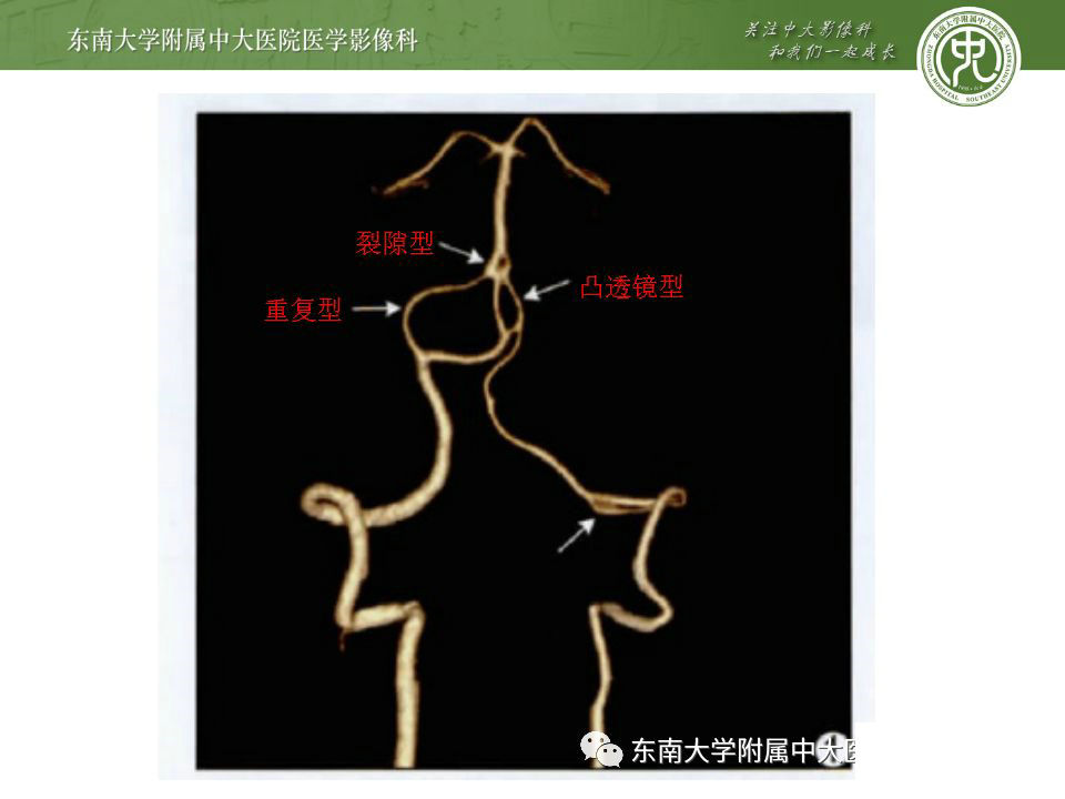 解剖头部血管解剖及willis环常见变异