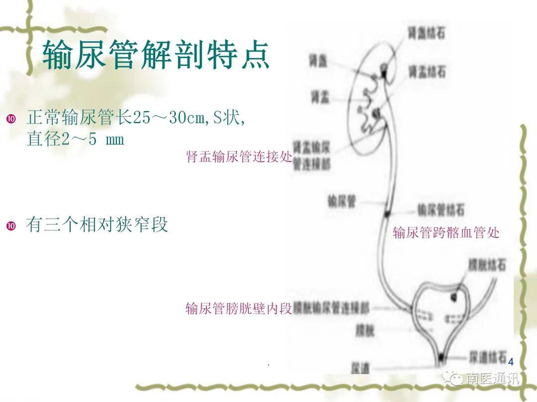 南华县人民医院科普专栏第5期—输尿管结石