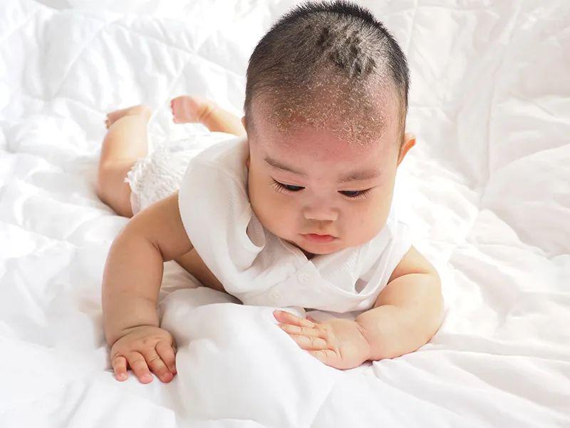[新生儿]先涂凡士林再轻轻抓洗新生儿有脂溢性皮炎怎么办？不必用力搓洗