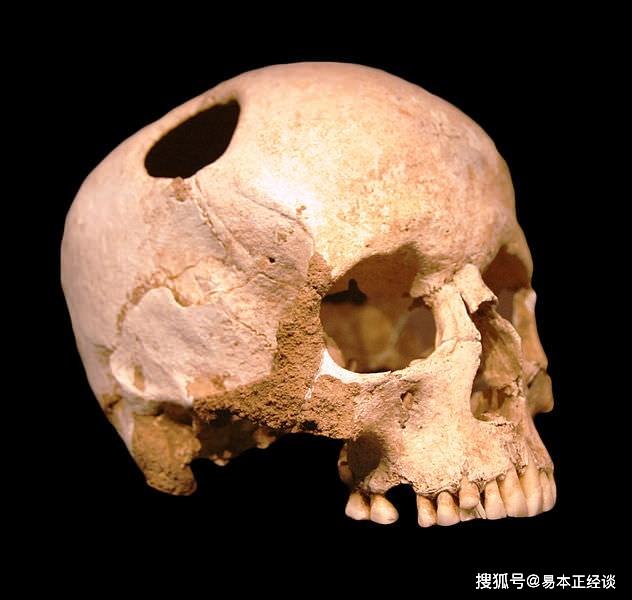 考古学家在法国发现了7000年前新石器时代的头骨,颅骨上的洞呈圆形