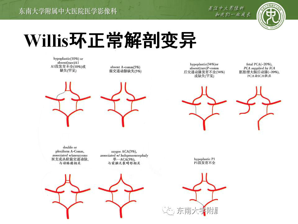 解剖头部血管解剖及willis环常见变异