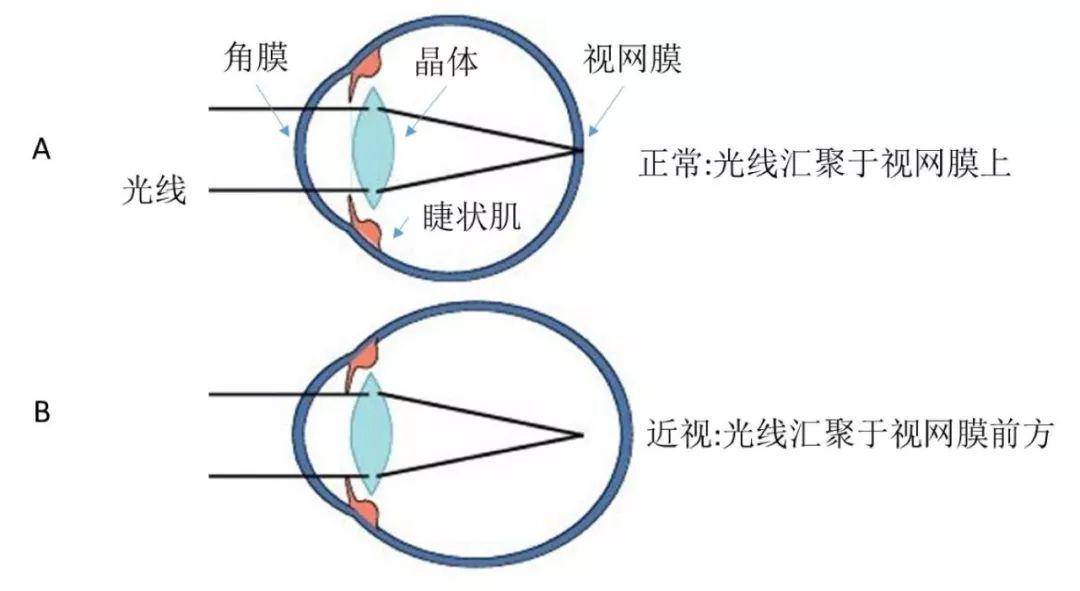 塑形镜的原理_△角膜塑形镜视力矫正原理(2)